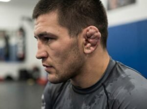 cauliflower ear